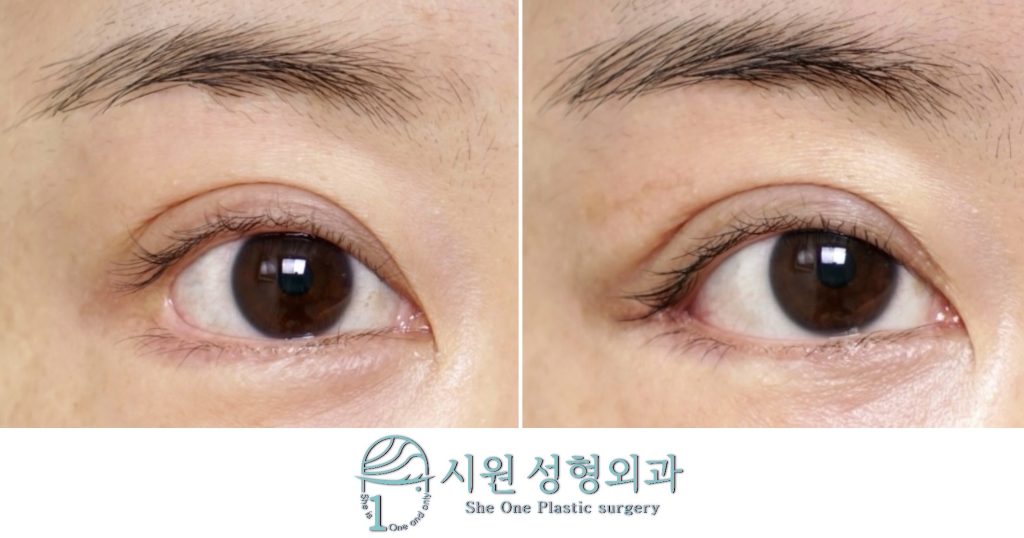 뒤트임복원3주차후기