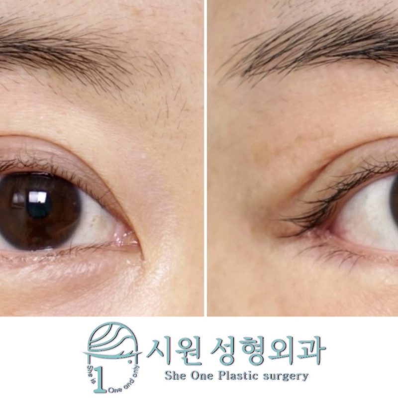 뒤트임복원3주차후기