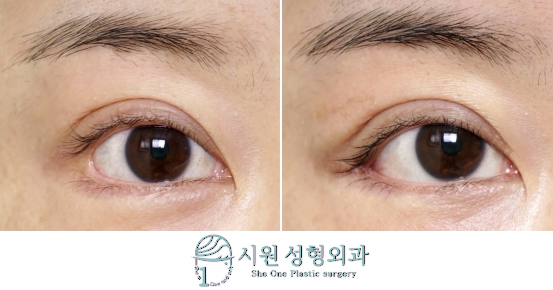 뒤트임복원3주차후기