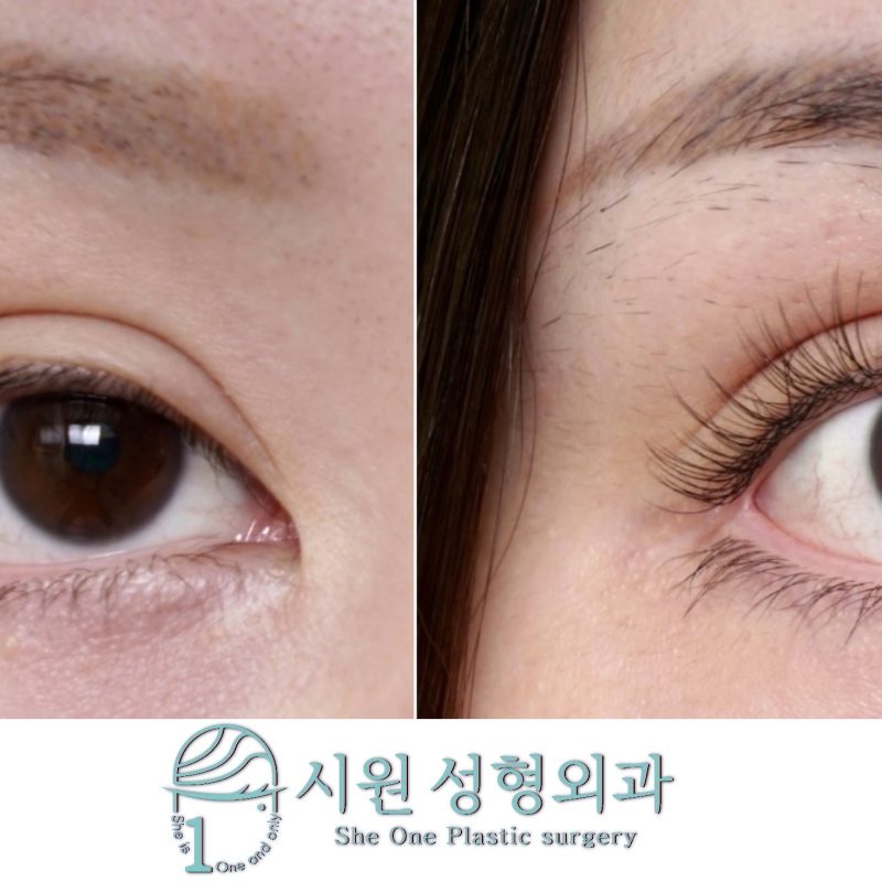 뒤트임 안검외반 복원 전후 비교