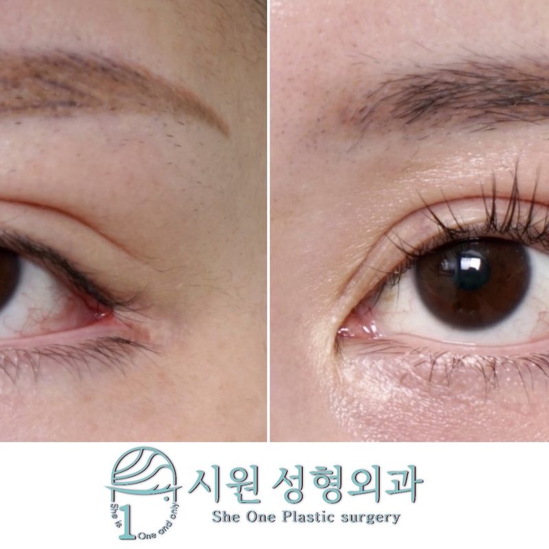 Lateral Canthoplasty Ectropion Revision Before and After