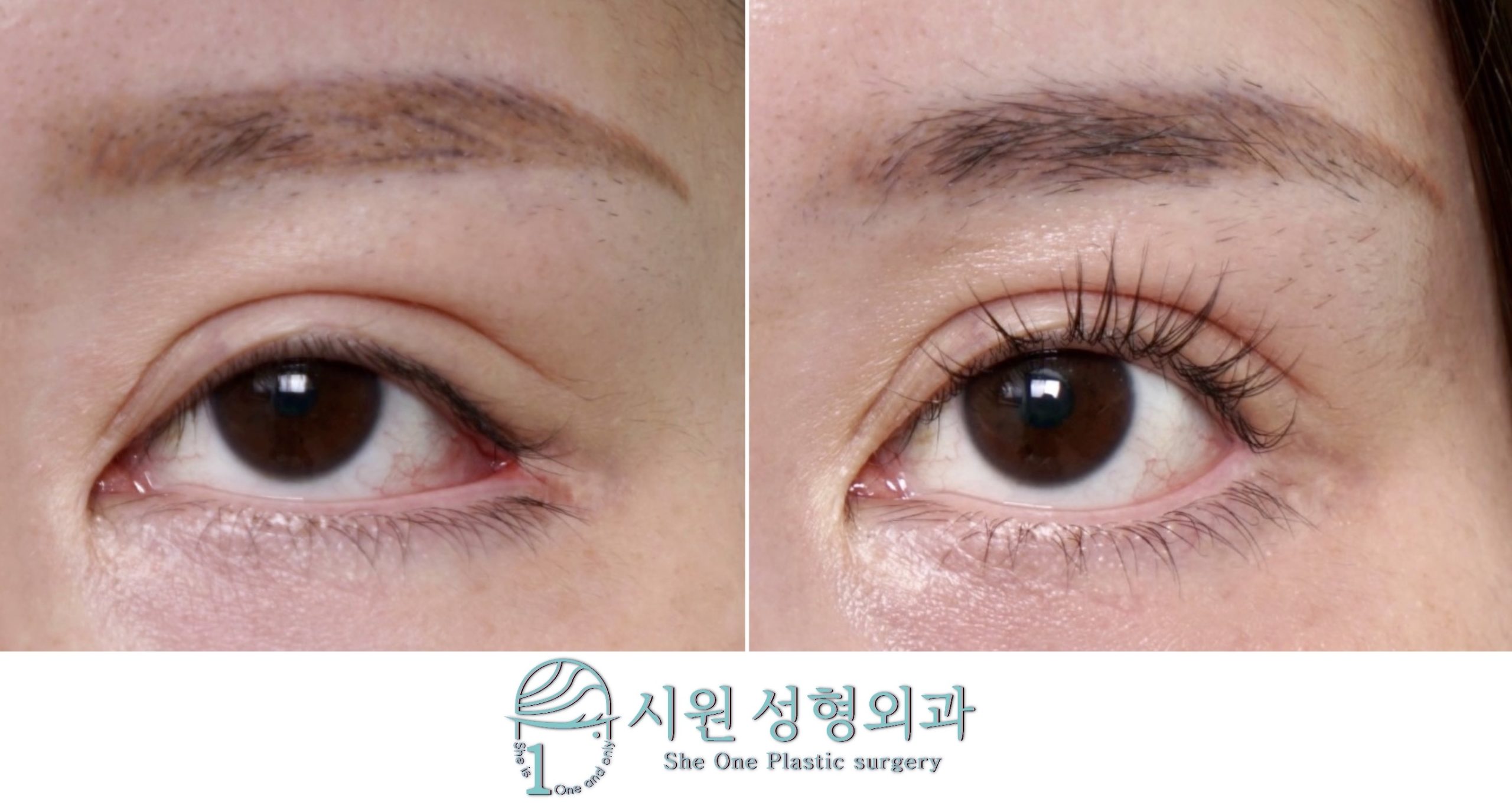 Lateral Canthoplasty Ectropion Revision Before and After
