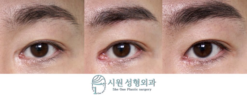 Staged Epicanthoplasty Scar Revision Before and After
