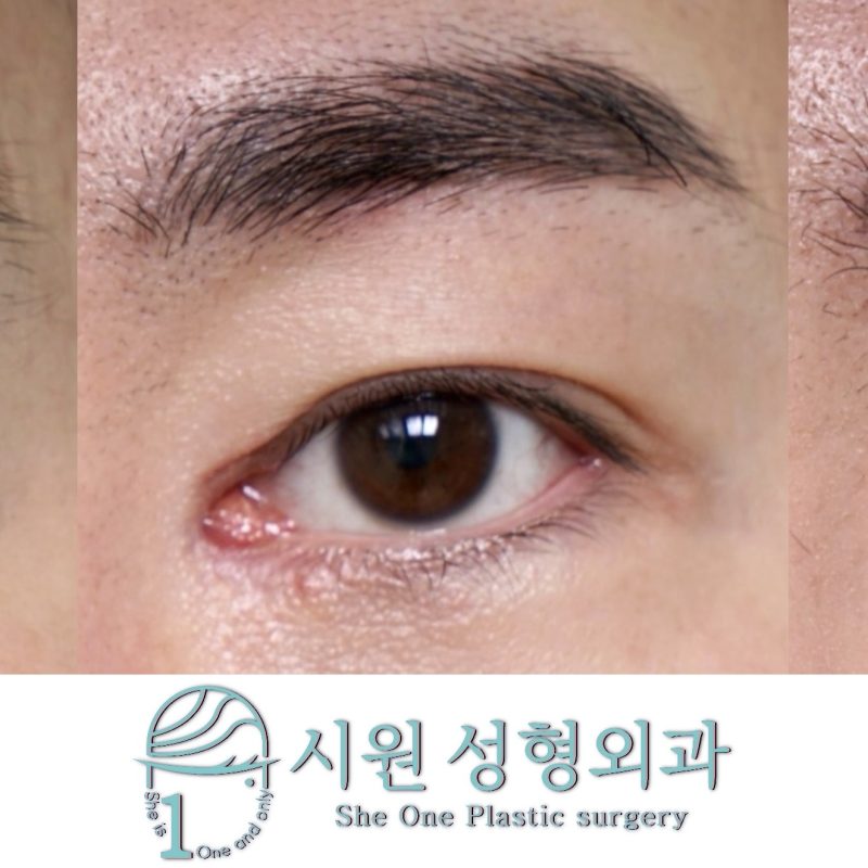 Staged Epicanthoplasty Scar Revision Before and After