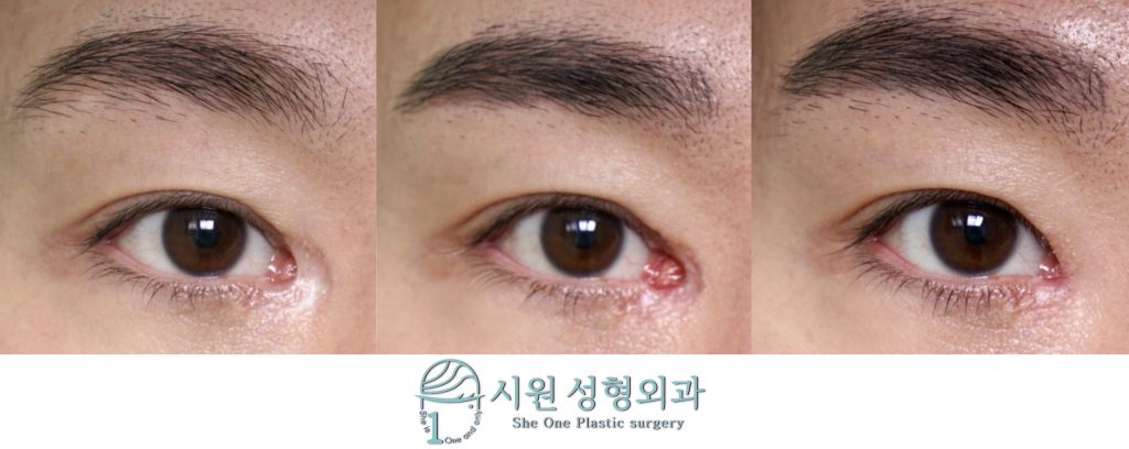 앞트임 흉터 단계적 복원 최종 결과