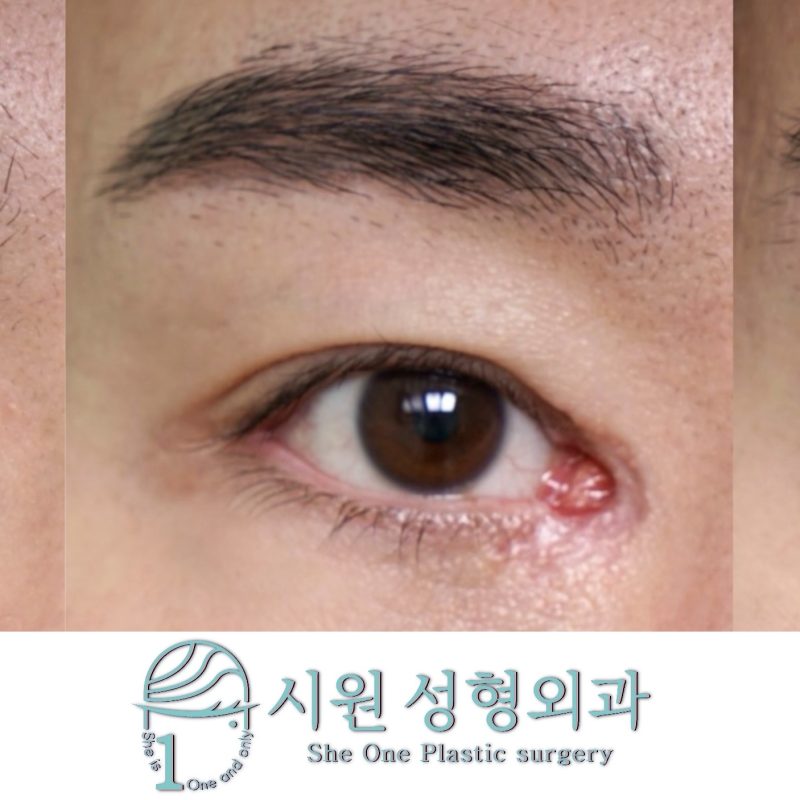 앞트임 흉터 단계적 복원 최종 결과