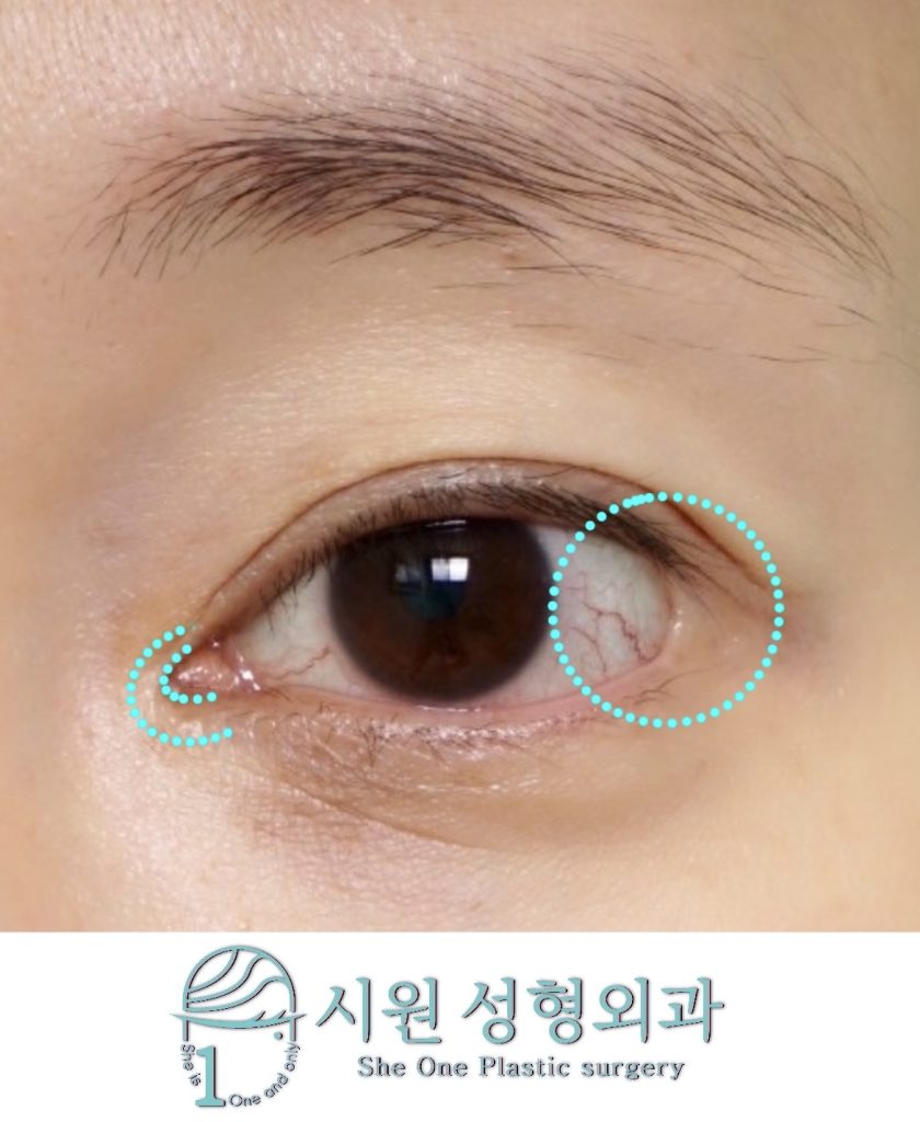 complication following medial and lateral canthopalsty : depressive scar and webbed deformity
