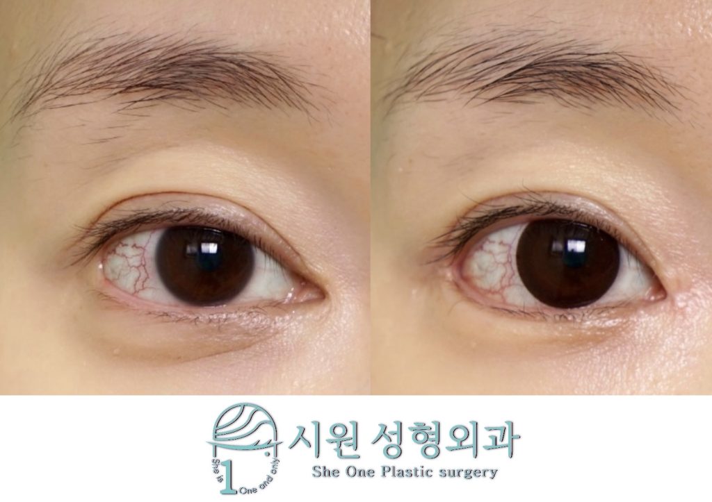 앞트임 뒤트임 동시 복원 전후 비교