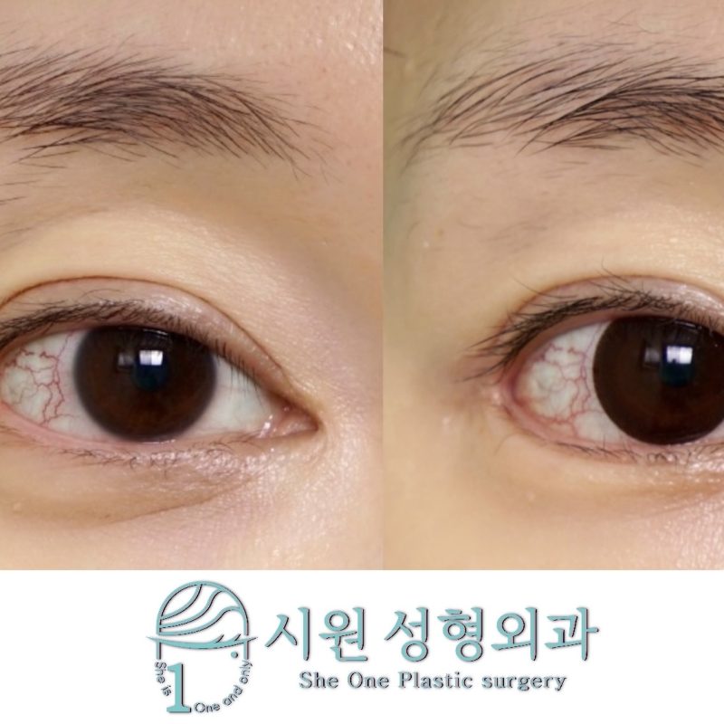 앞트임 뒤트임 동시 복원 전후 비교