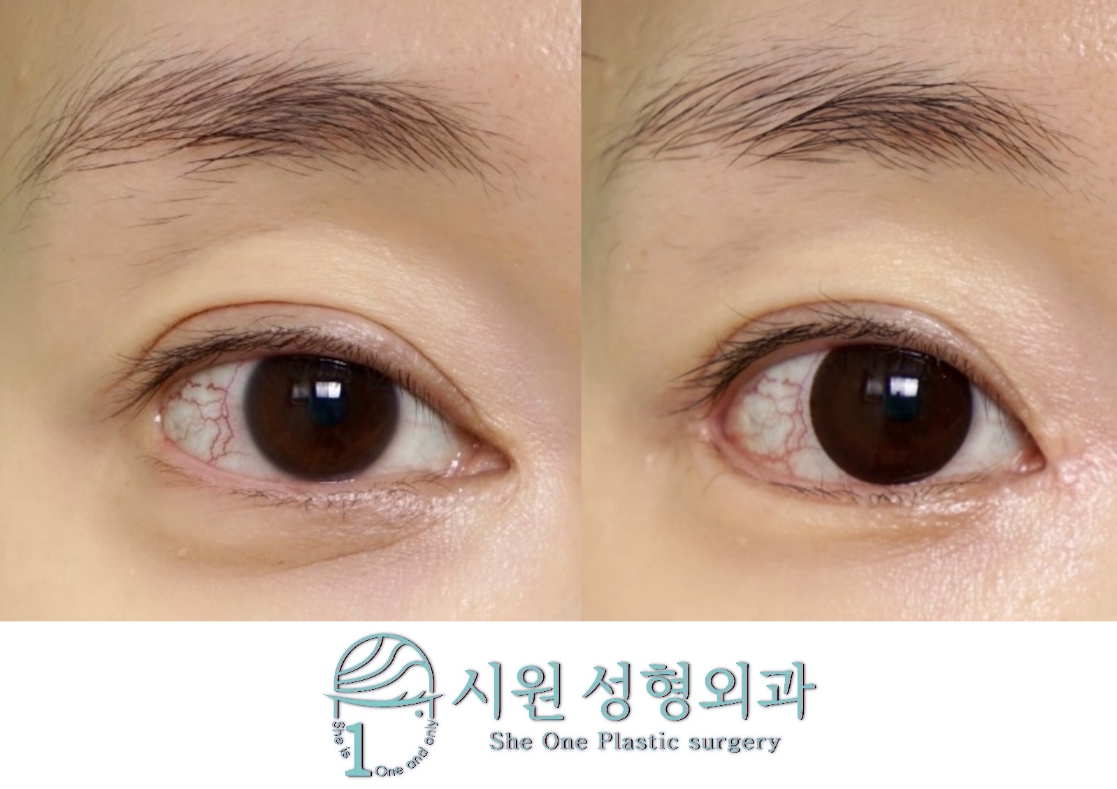 앞트임 뒤트임 동시 복원 전후 비교