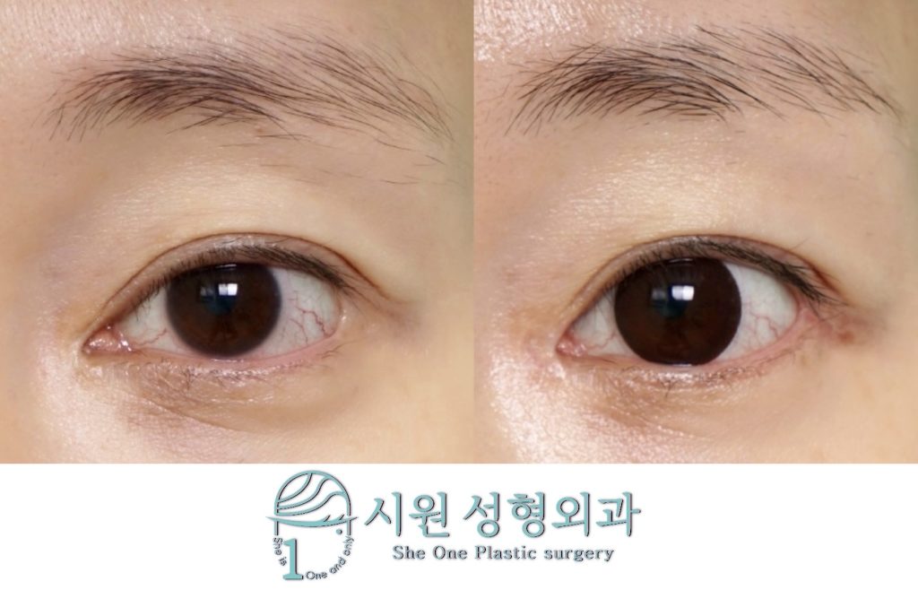 Simultaneous Canthoplasty Revision Before and After