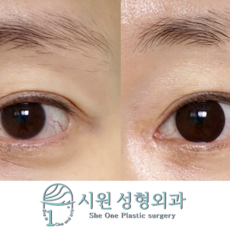 Simultaneous Canthoplasty Revision Before and After