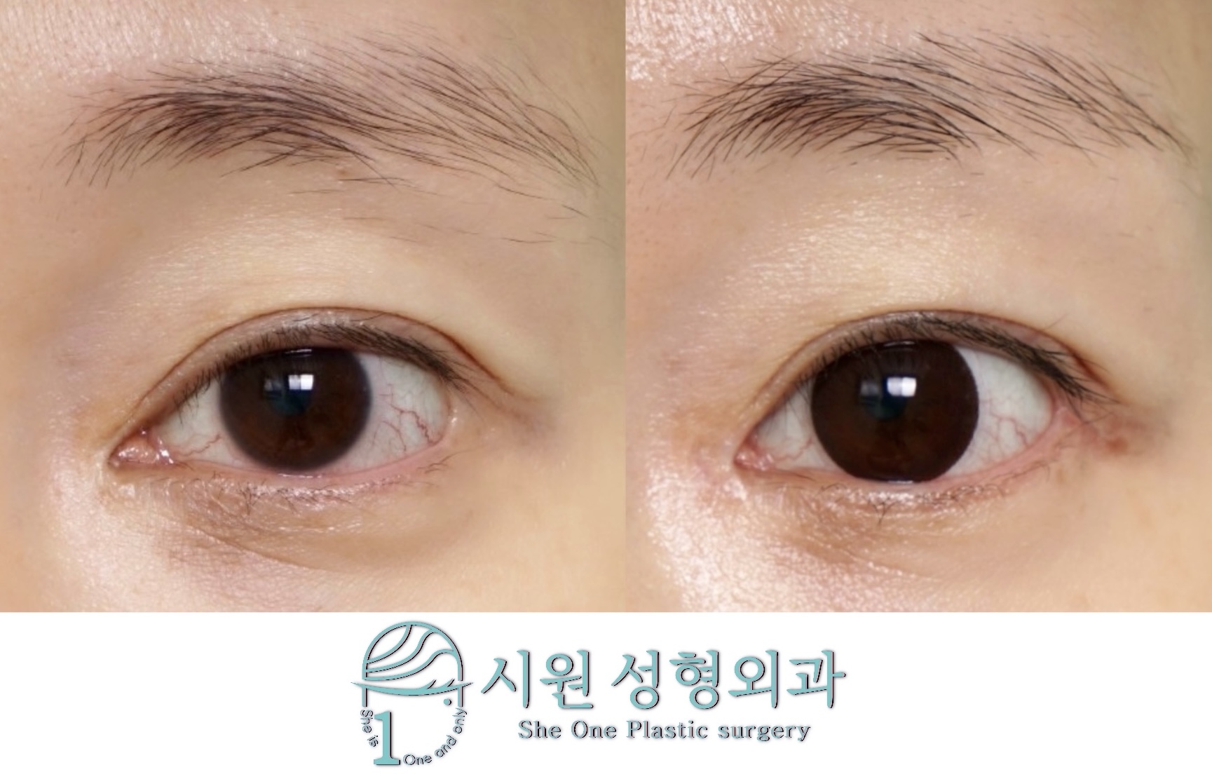 Simultaneous Canthoplasty Revision Before and After