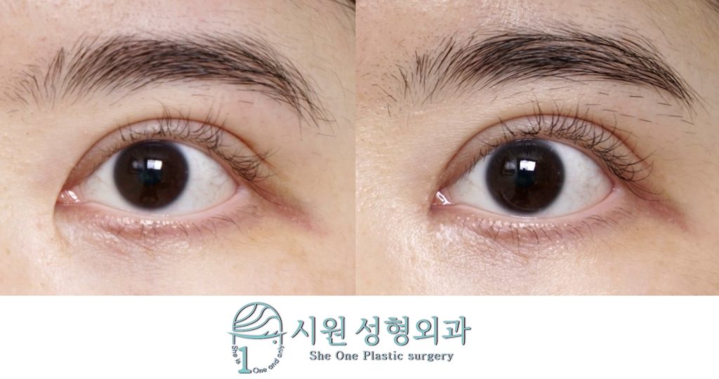 Epicanthoplasty revision 2-month results, showing corrected scars and folds (26.07.27)