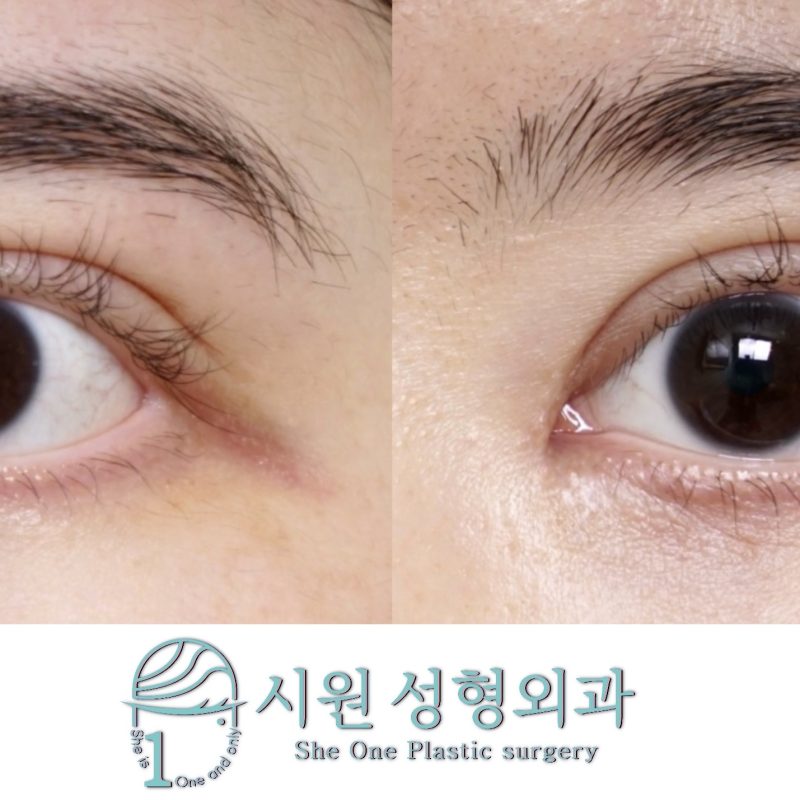 Epicanthoplasty revision 2-month results, showing corrected scars and folds (26.07.27)