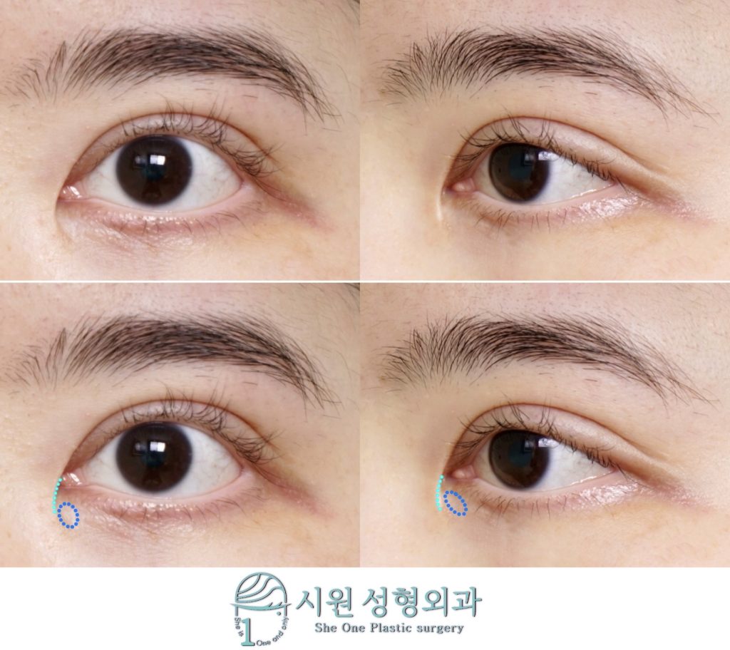 Pre-surgery state of inner corner scar and epicanthal fold (26.05.27)