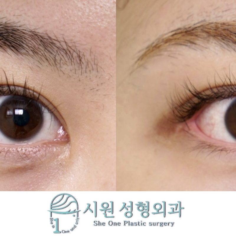 ㄷ자 눈꼬리 변형 및 점막 노출 교정 2개월 후 경과