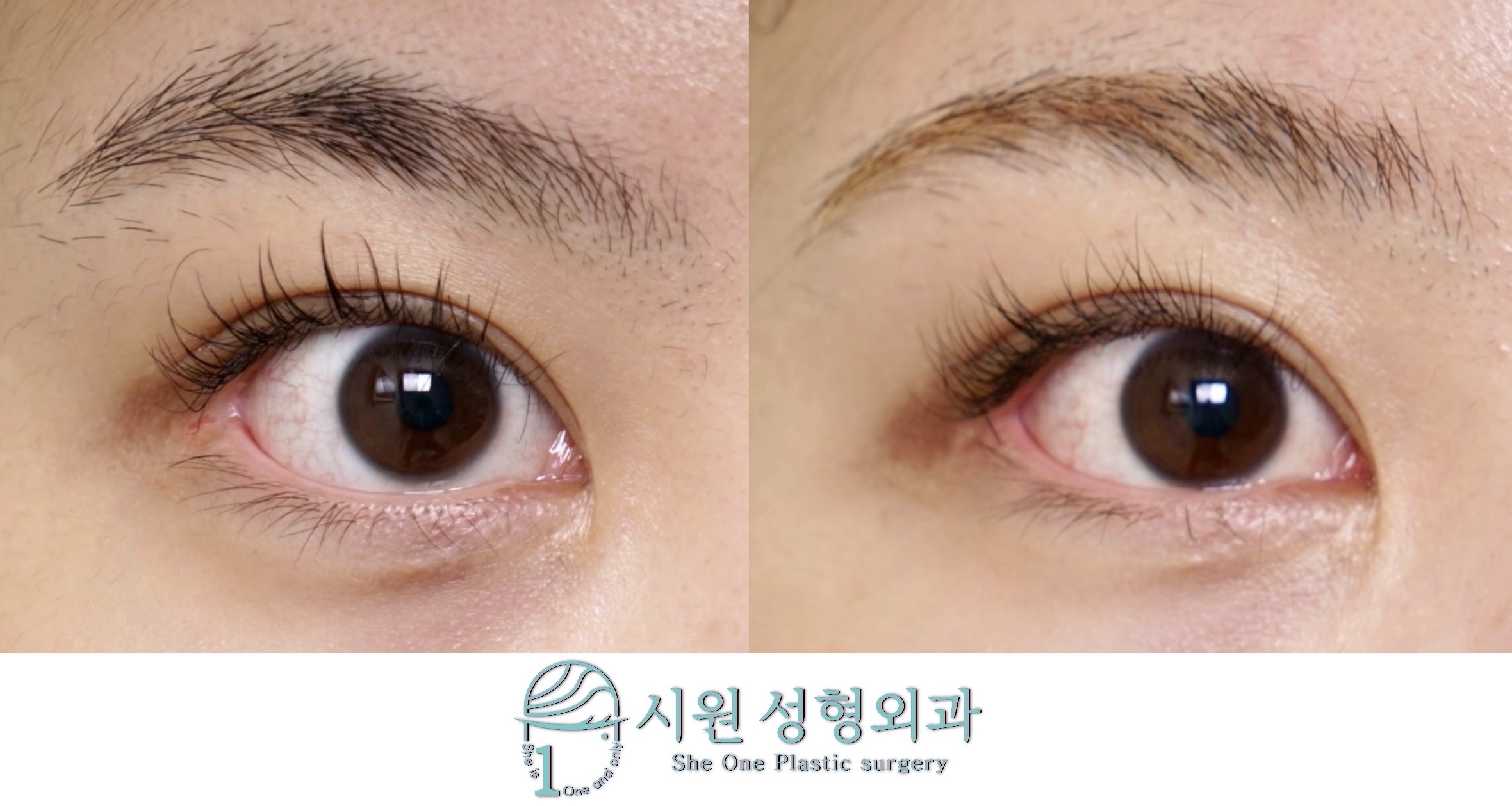 ㄷ자 눈꼬리 변형 및 점막 노출 교정 2개월 후 경과