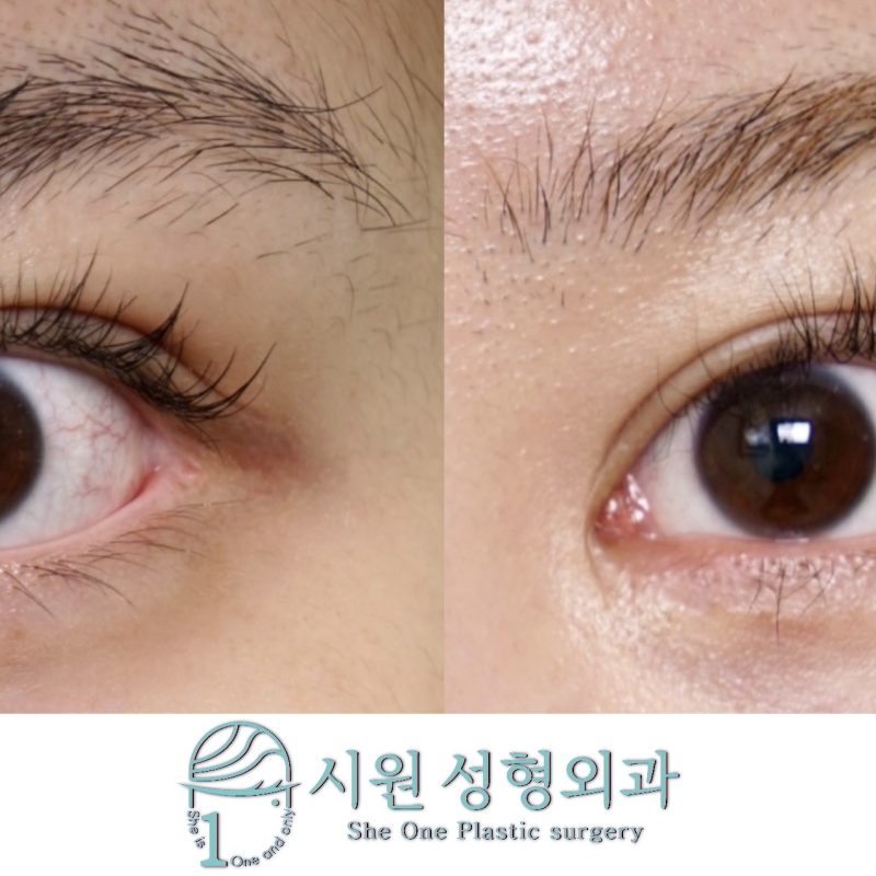 2-month progress of blunt outer corner deformation and mucosal exposure correction