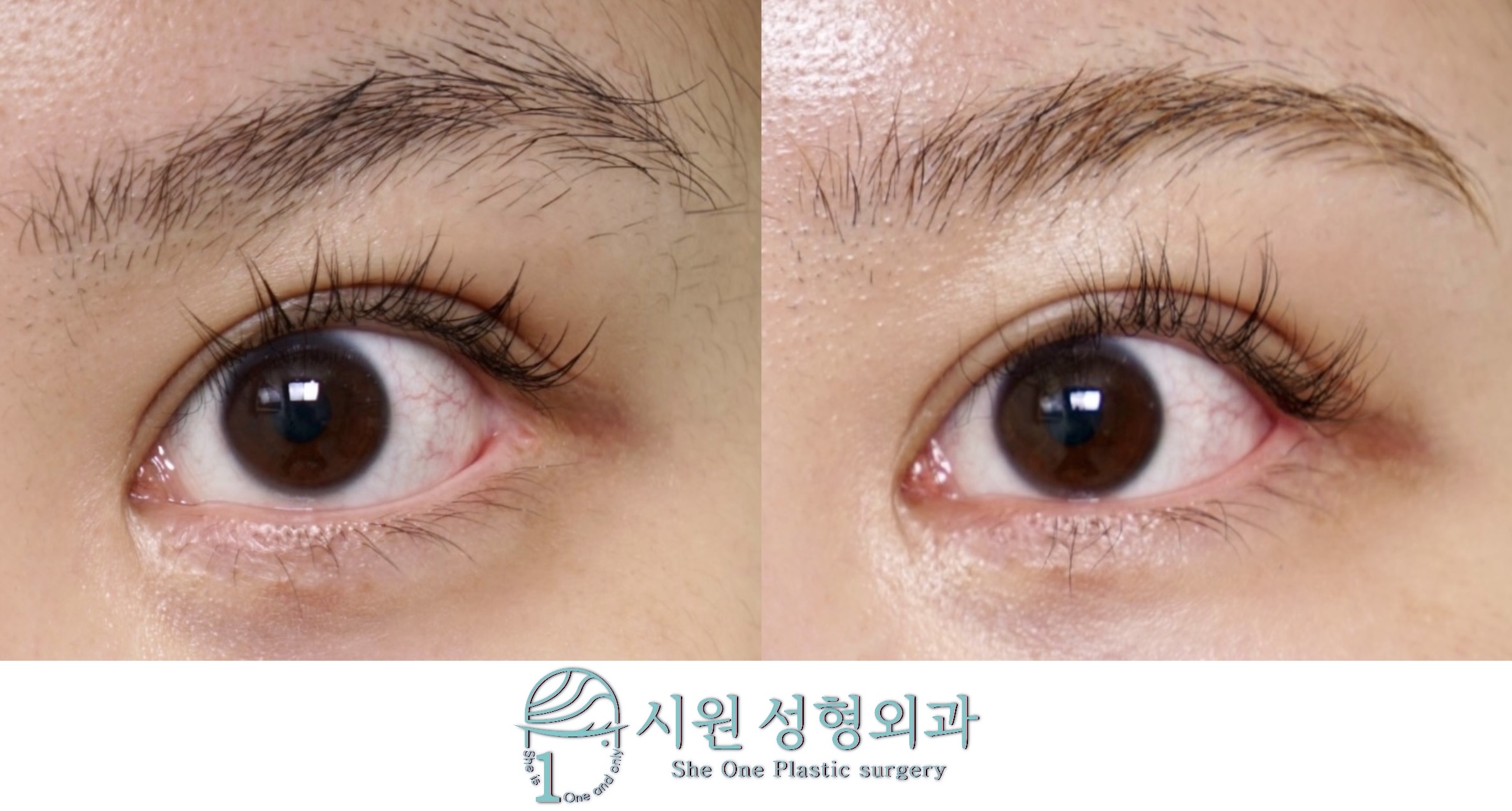 2-month progress of blunt outer corner deformation and mucosal exposure correction