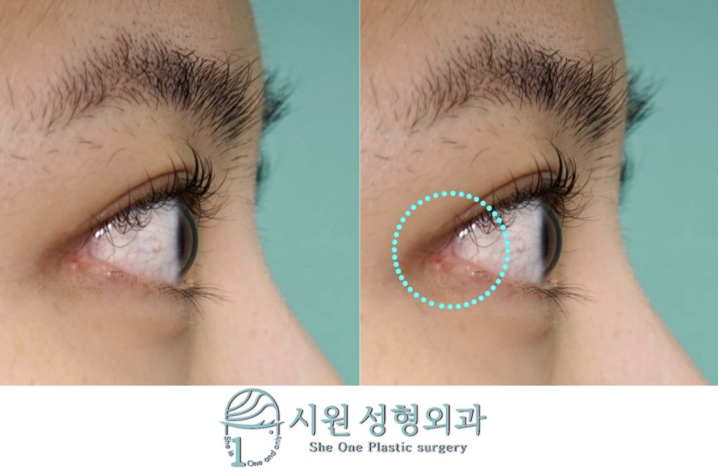 뒤트임 부작용 재건을 위한 눈꼬리 변형 정밀 분석