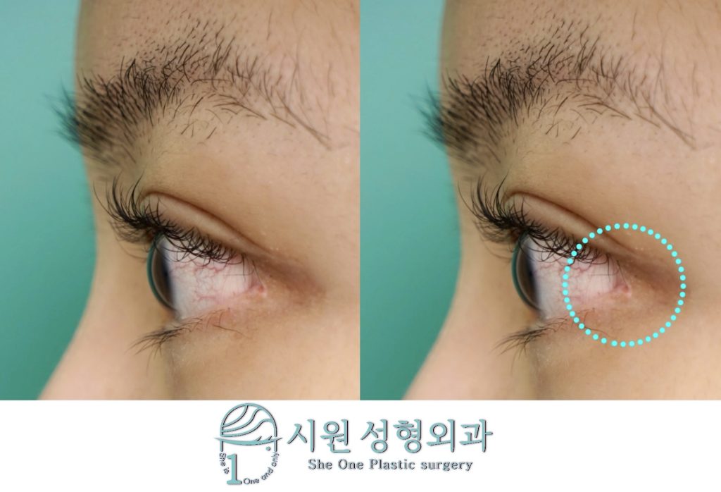 Precise analysis of outer corner deformation for lateral canthoplasty side effect revision