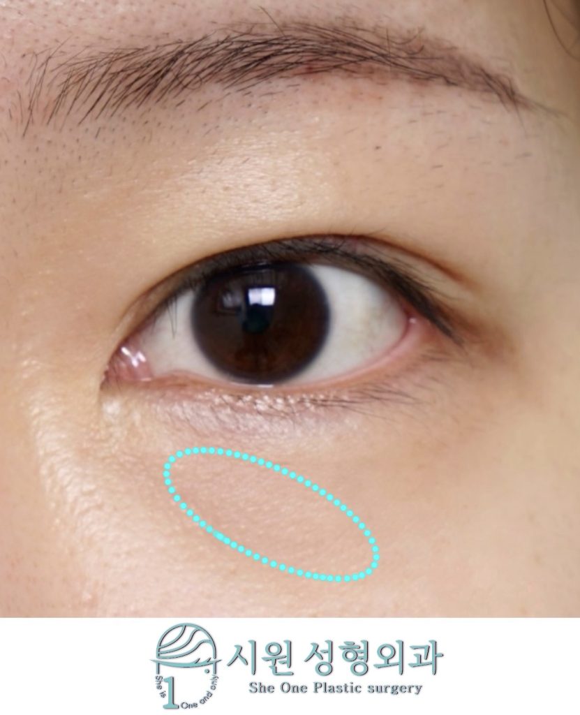 Preoperative state of lower eyelid fat bulging