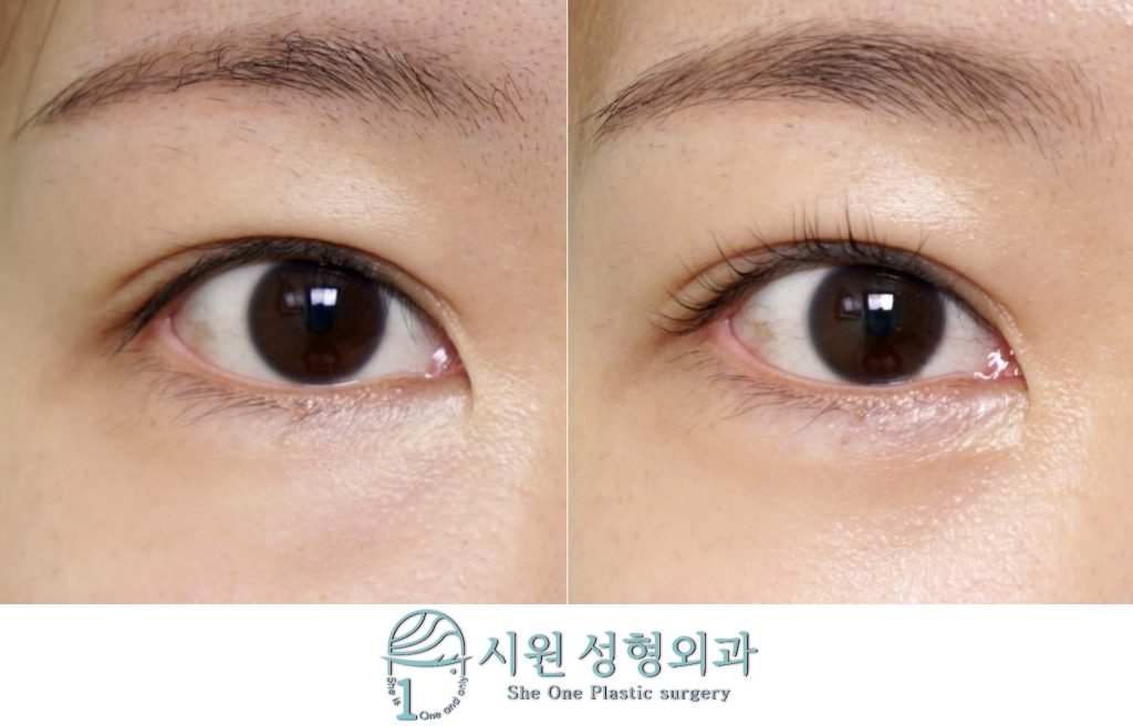 눈밑지방재배치 2개월 차 눈 밑 돌출 및 눈물고랑 개선 정면 비교