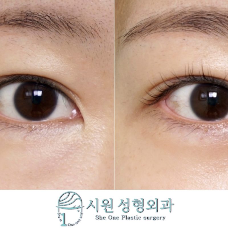 눈밑지방재배치 2개월 차 눈 밑 돌출 및 눈물고랑 개선 정면 비교