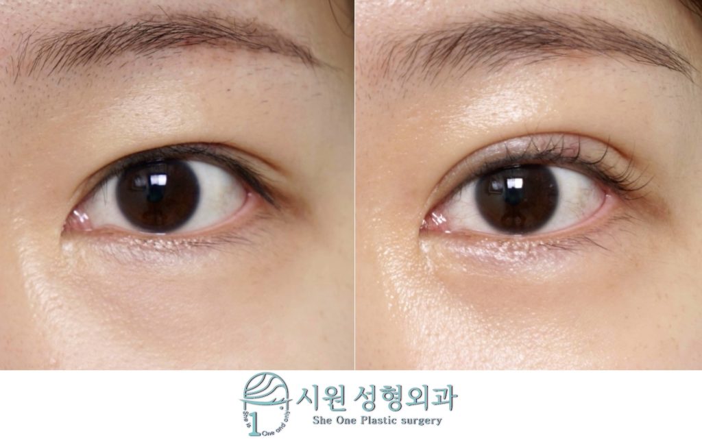 Frontal comparison of lower eyelid fat repositioning after 2 months