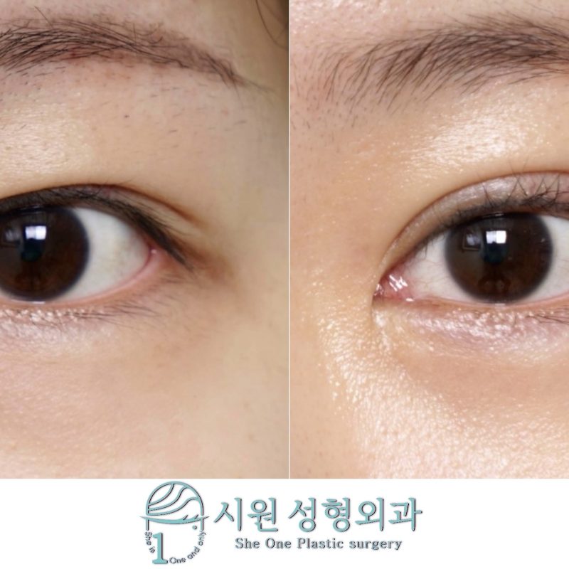 Frontal comparison of lower eyelid fat repositioning after 2 months
