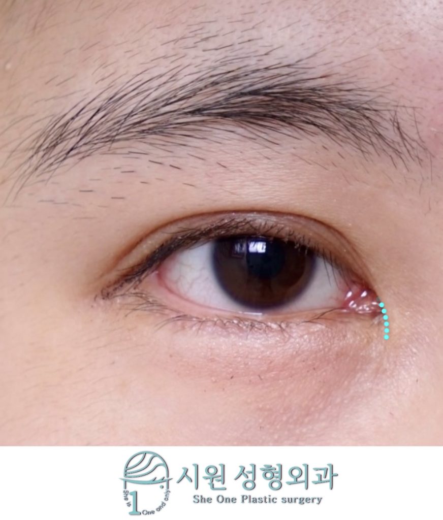갈고리눈매의 몽고주름