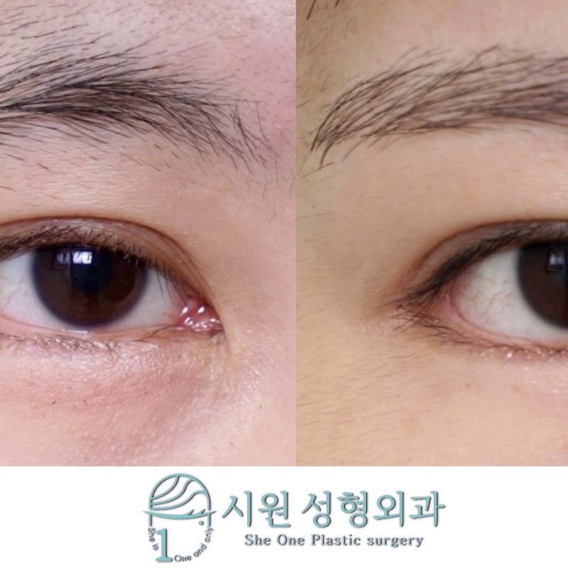 앞트임, 축돌리기 윗트임, 뒤트임재수술, 밑트임재수술 전과 22개월 후 비교
