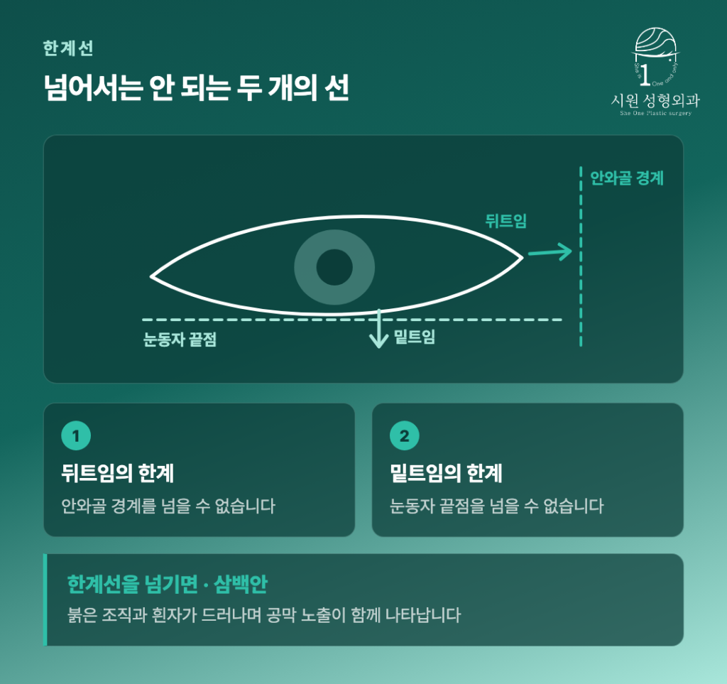 뒤트임과 밑트임의 한계선 및 삼백안 형성