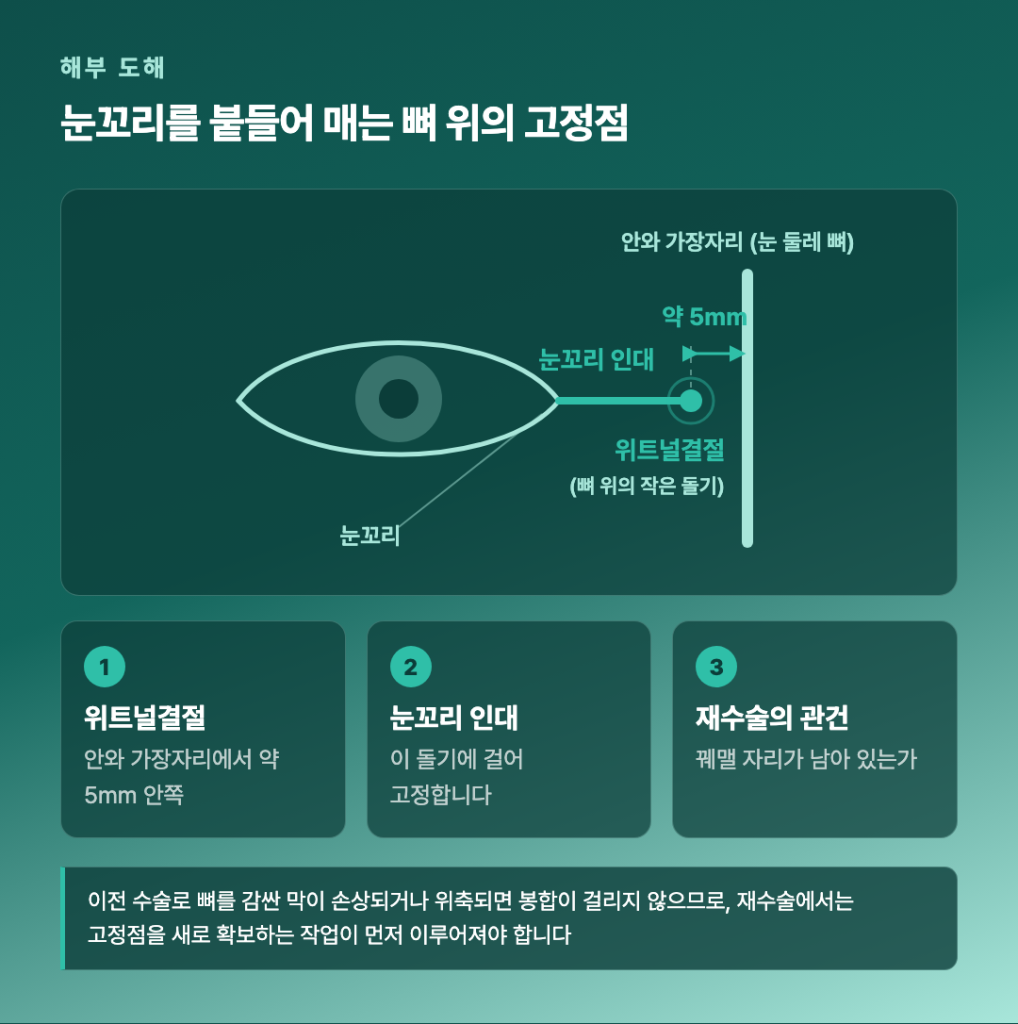 눈꼬리 인대의 뼈 고정점 위치를 표시