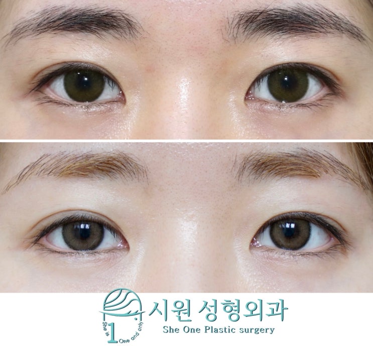 밑트임 전후 비교 — 아래 눈꺼풀 선 모양 변화