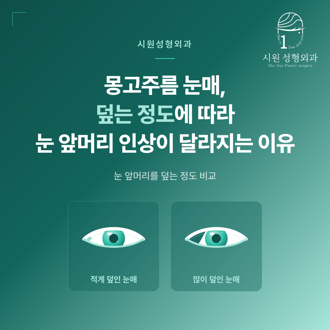 몽고주름 눈매 인상 차이를 비교한 그림