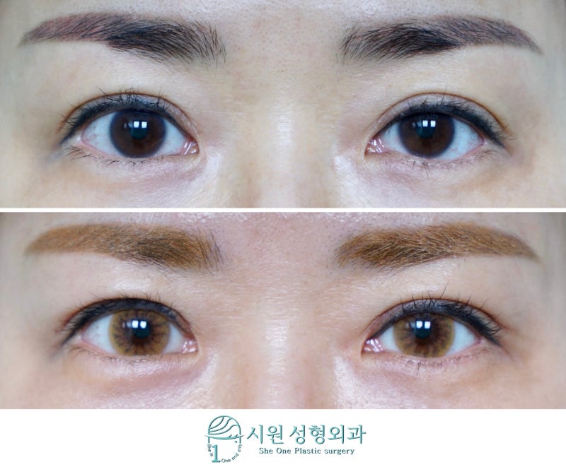 A lower-corner side effect reversed, before and after two months