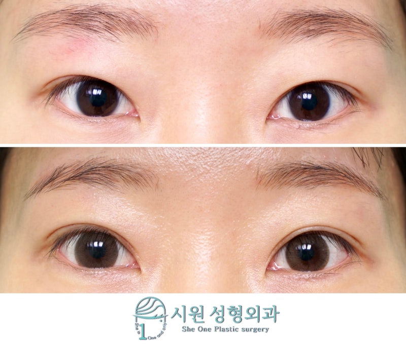 A crease revision without an incision, before and after
