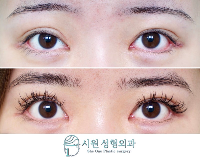 A sausage-like lid with an outer-corner scar, before and after