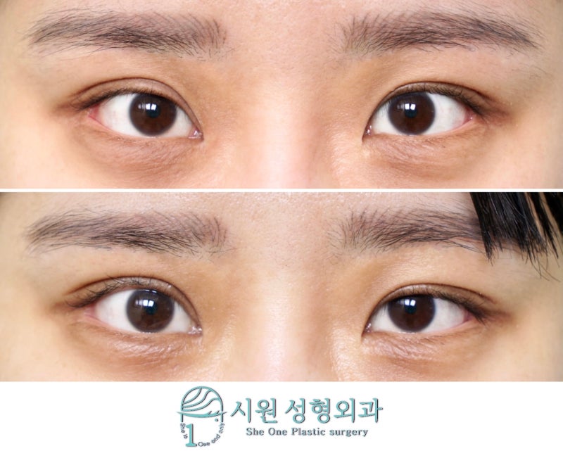A straightened inner end of the crease, before and after