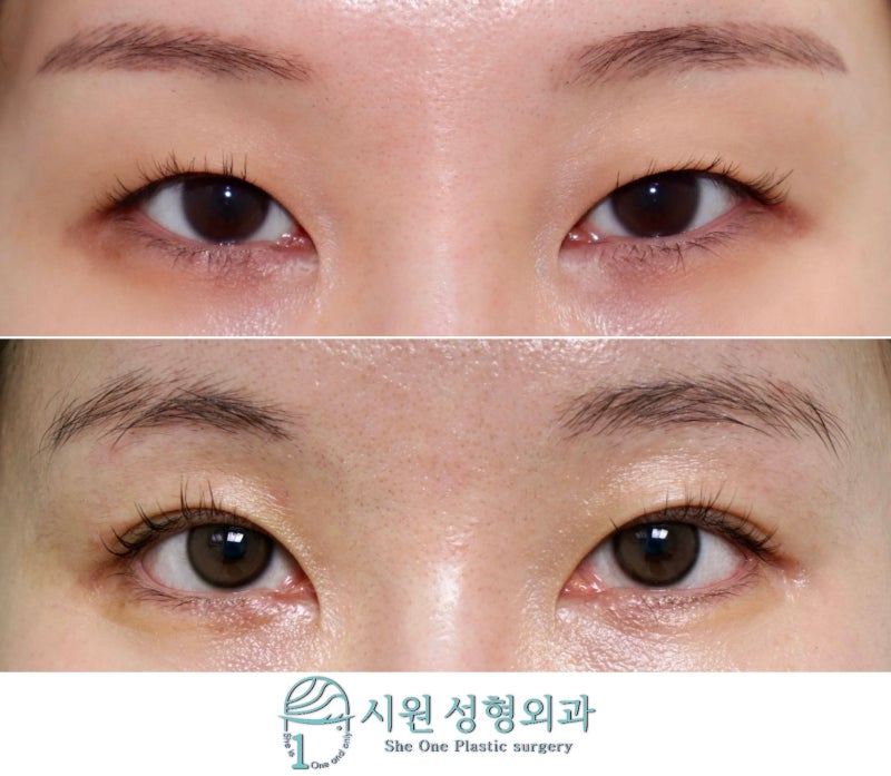Outer and lower corner opening, before and after four years three months