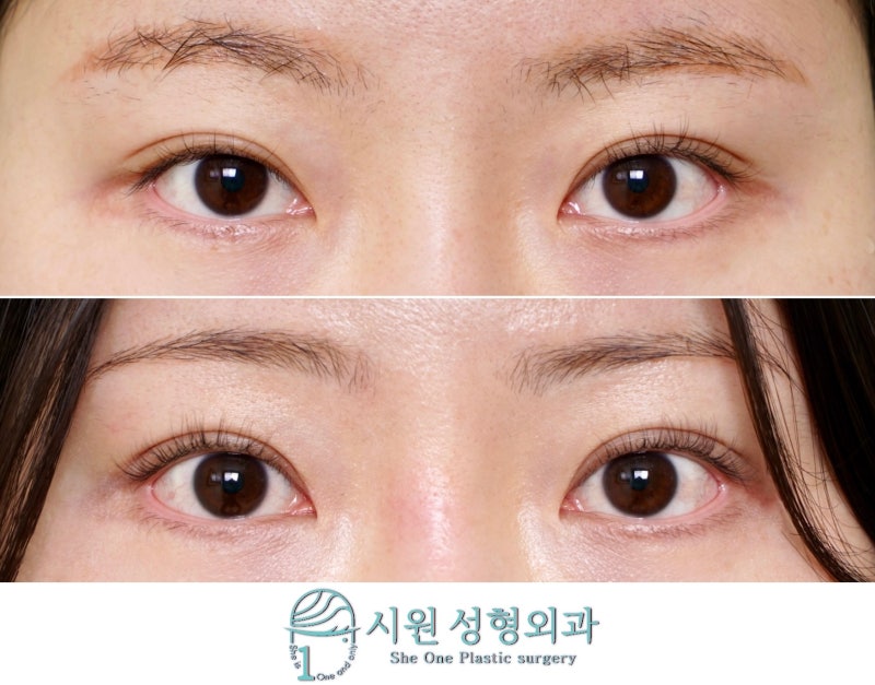 One-sided ptosis correction, before and after