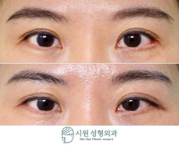 한쪽만 뒤트임복원한 2개월 차 수술 전후 비교