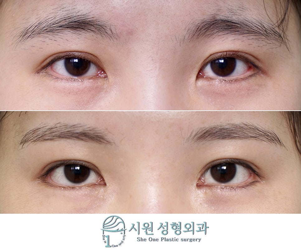 Before and 22 months after, front view with the eyes open