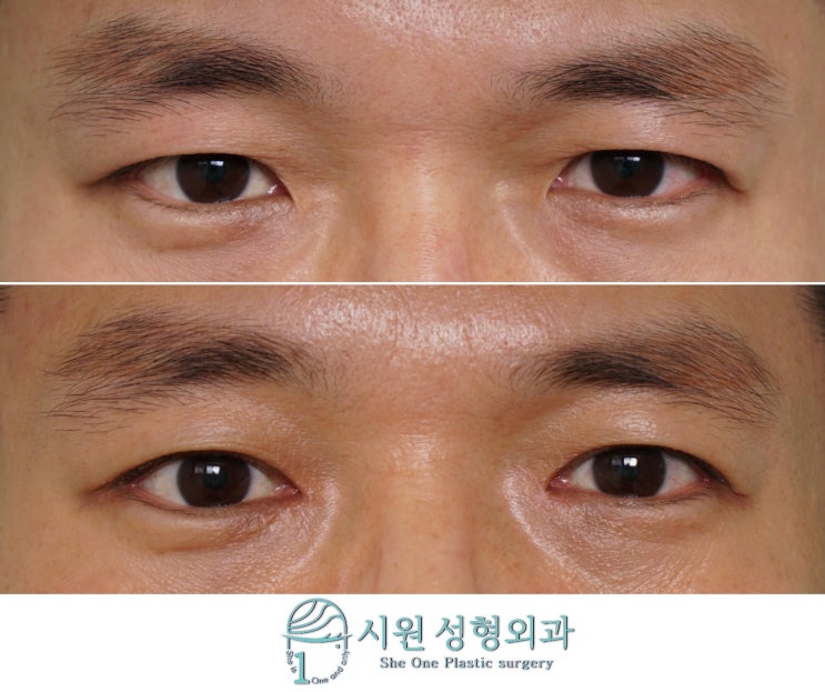 남자 앞트임 단독 수술 전후 비교 — 눈 앞머리 모양 변화