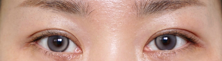 자연유착쌍꺼풀 쌍꺼풀재수술 수술 후 434
