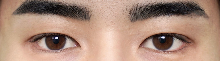 뒤트임복원 뒤트임 자연유착쌍꺼풀 수술 후 336
