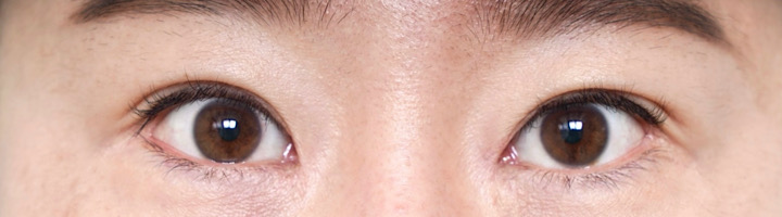 앞트임복원 수술 후 349