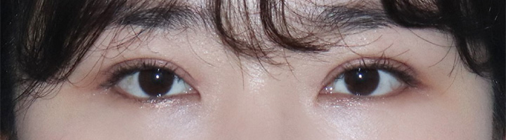 뒤트임 밑트임 눈매교정 수술 후 86